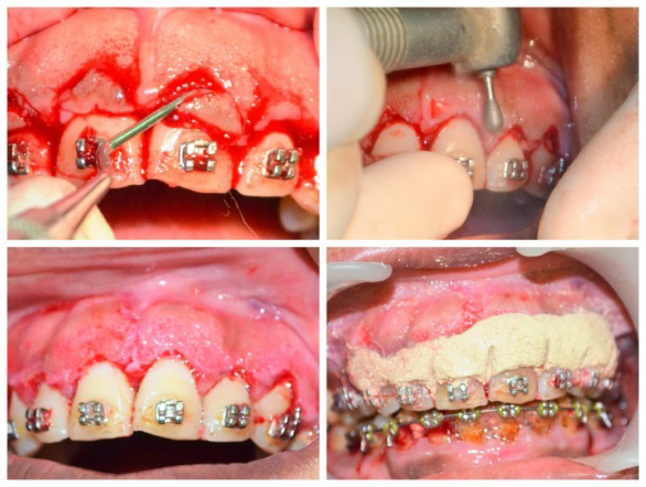 Figure 3: Surgical procedure for plastic periodontal therapy.