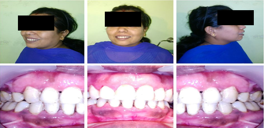 Figure 4: Three months after plastic periodontal therapy.