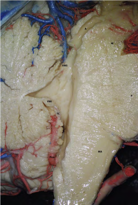 Figure 1: Sagittal Section of the IV Ventricle. A: Cerebral Aqueduct; MA: Midbrain; VMS: Superior Medullary Velum; VMI: Inferior Medullary Velum; TC: Tela Choroidea; P: Protuberance; MA: Bulb; PICA: Posteroinferior Cerebellar Artery Rhoton A, Peris-Celda M, Martínez Soriano F. Rhoton - Atlas Of The Head, Neck And Brain.