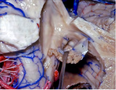 Figure 3: Lateral Recess. 1: Rhomboid Lip; 2: Choroid Plexus; 3: Tela Choroidea; 4: Anterior Inferior Cerebellar Artery Rhoton A, Peris-Celda M, Martínez Soriano F. Rhoton - Atlas of the Head.