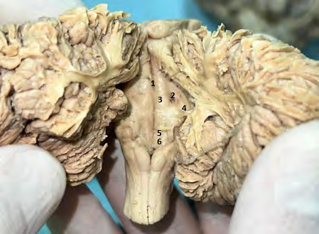 Figure 6: Floor of the IV Ventricle 1: Posterior Longitudinal Groove; 2: Sulcus Limitans 3: Facial Colliculus; 4: V+Estibular Area; 5: Hypoglossal Trigone; 6: Vagus Trigone.