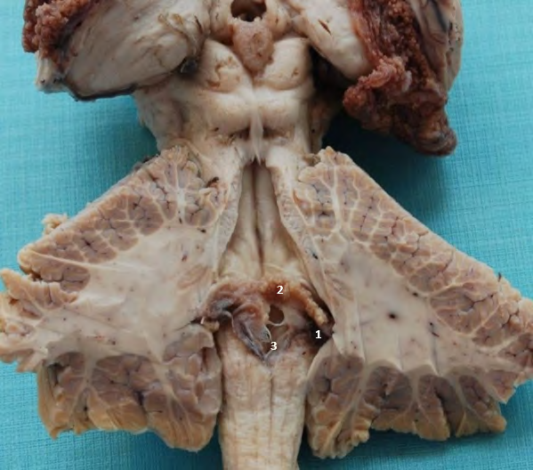 Figure 7: Floor of the IV Ventricle.