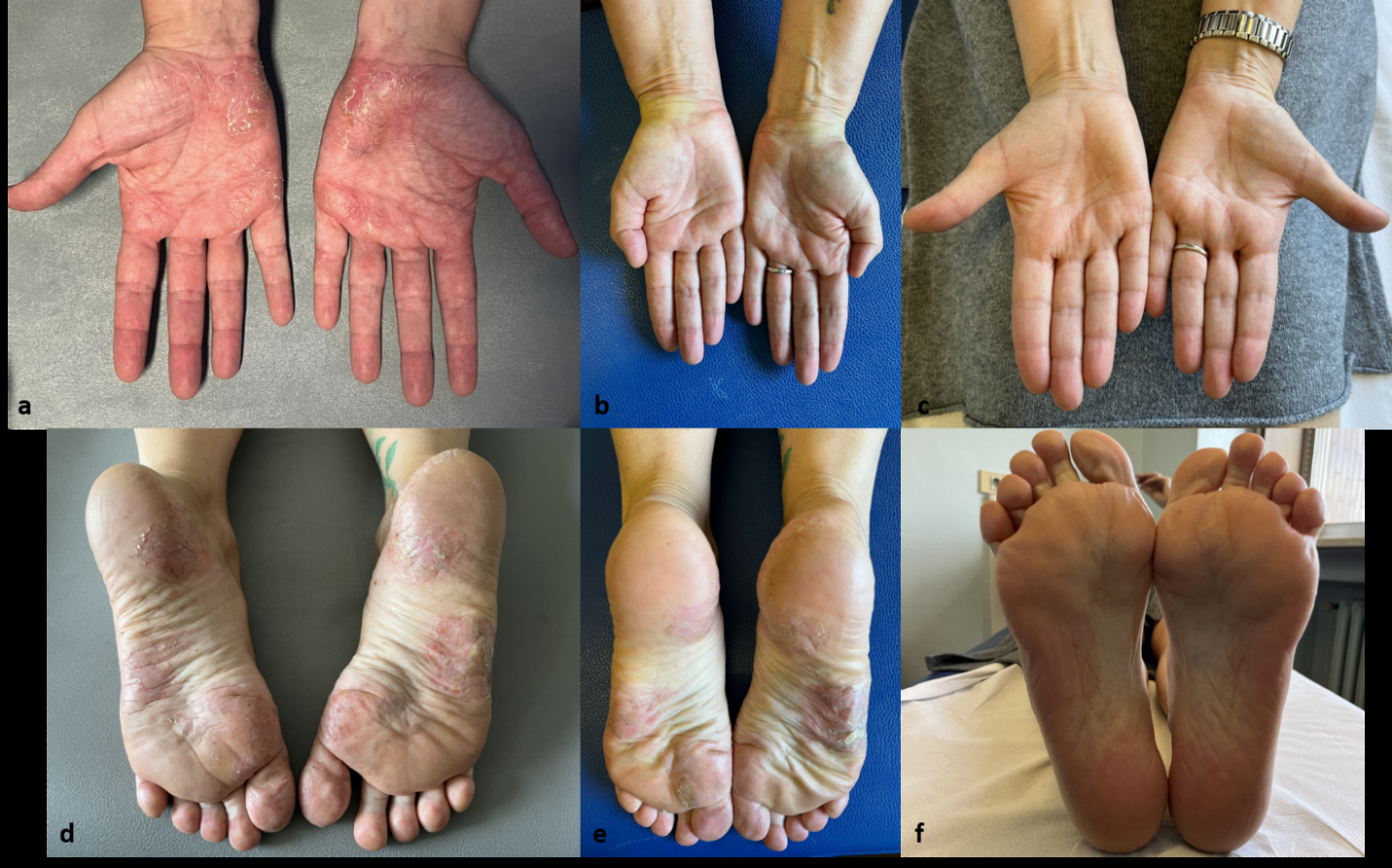 Figure 1: Palmo-plantar psoriasis in a 62-year-old women at the baseline (a,c), after 16 weeks (b,d) and after 28 weeks (e,f) of therapy with tildrakizumab. Palmoplantar Pustular Psoriasis Area and Severity Index (PPPASI) dropped from 21.6 to 10.2 after 16 weeks and to 2.4 after 28 weeks.