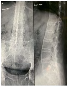 Figure 1: Obliteration of most of the facet joint ,bridging syndesmophytes between all lumbar vertebrae and loss of lordosis.