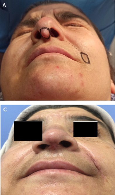 Figure 1: A: designing the flap, B: Flap inset (a bleeding point can be seen inside the red circle), C: postoperative 3rd week.
