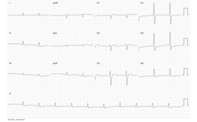 Figure 1: Baseline ECG.
