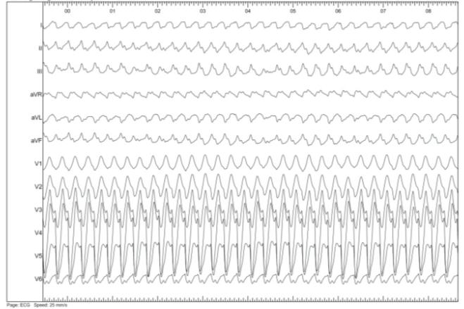 Figure 4: Sustained Monomorphic Ventricular Tachycardia