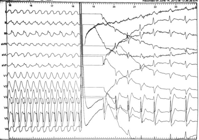 Figure 5: Defibrillation. The event was considered non pronostic of higher risk for further arrhythmic events during follow-up. As a result, an usual management of asymptomatic patients according to Brugada Syndrome guidelines was performed, focused in lifestyle changes.