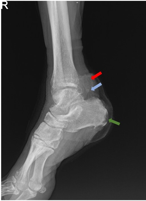 Figure 1: Lateral radiograph of the right ankle. Obliteration of Keger’s fat pad by a soft tissue density (red arrow) with small corticated bone fragment at the distal AT (blue arrow). Subcortical lucency in the posterior aspect of calcaneal tuberosity; representing osteonecrosis (green arrow).