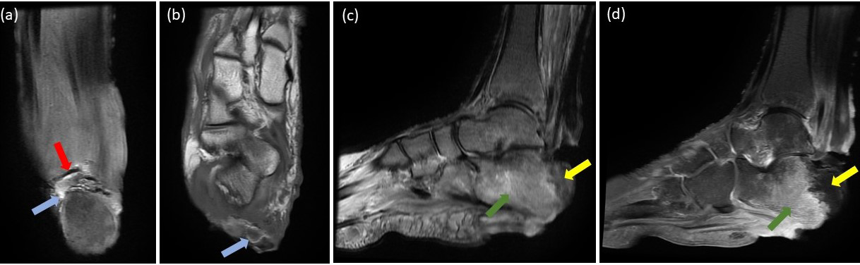Figure 3: MRI of the right ankle. Coronal T1 fat saturation (a) and axial T1 (b) images demonstrate AT fibers disruption (red arrow) with intervening high signal intensity (blue arrow); representing AT tear with acute hematoma. Sagittal STIR (c) and T1 post contrast (d) images demonstrate bone marrow edema in the posterior calcaneal process (green arrow). The posterior calcaneal tuberosity show low STIR signal intensity with no enhancement in T1 post contrast image; representing osteonecrosis (yellow arrow).