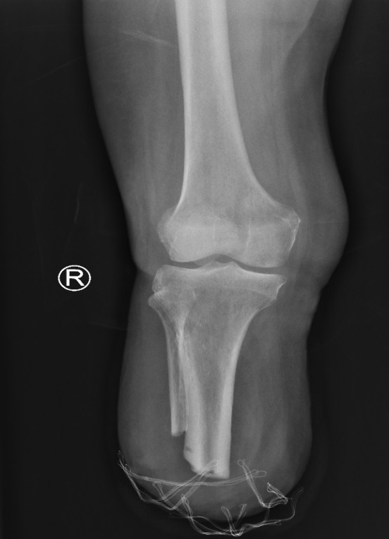 Figure 4: Frontal radiograph of the right leg. Below knee amputation.