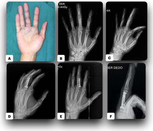 Figure 3: ** 25 years old patient with blunt trauma on third finger – right hand.