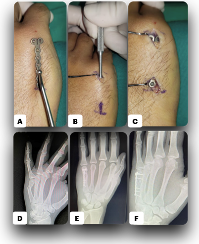 Figure 4: ** Patient with high blunt trauma on the hand at fifth metacarpal area.