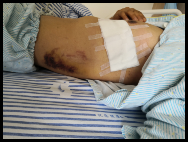 Figure 1: A skin ecchymosis is seen on the left abdominal wall of the case.