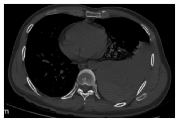 Figure 4: A Thoracic CT scan suggested a large left pleural effusion.