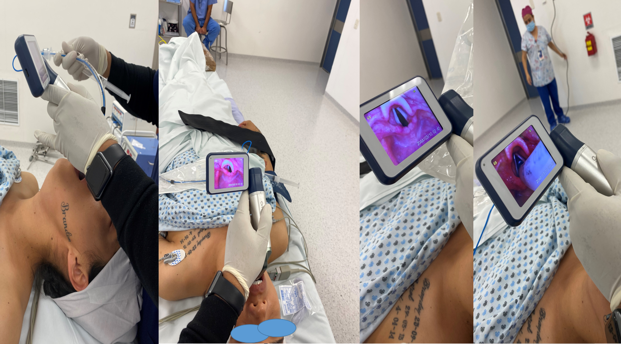 Figure 3: 1st attempt without incidents or complications.