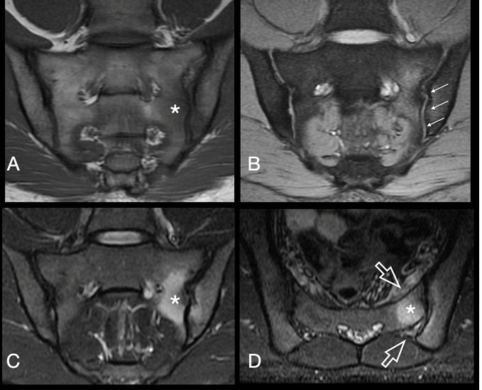 Figure 1: Coronal oblique T1 weighted MRI (A) shows ill-defined low signal at left subarticular sacral marrow (*). Corresponding GRE image (B) exhibits smooth cortical outline ( multiple white arrows) at the left sacro-iliac joint with absence of significant joint effusion on coronal oblique fat supressed proton density image (C) ruling out the possibility of inflammatory or infective pathology. Axial STIR images (D) show mildly edematous pre-sacral and post-sacral soft tissue edema (open arrows).