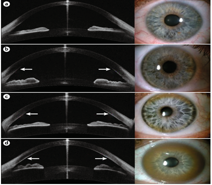 Figure 4: Wilson’s Disease.