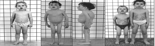 Figure 5: Gaucher’s Disease.