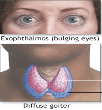Figure 8: Hyperthyroidism.
