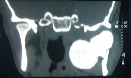Figure 3: Non-Contrast CT Showing the Lesion.