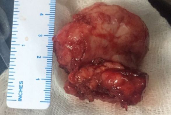Figure 4: Specimen after Surgical Excision.