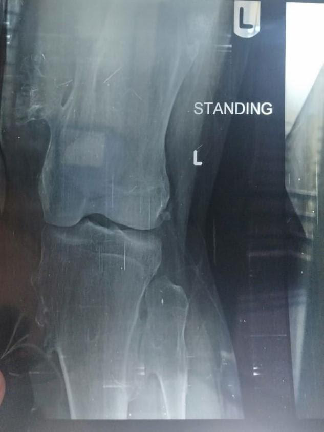 Figure 1: Multiple Exostoses in X-ray Pre-surgical.
