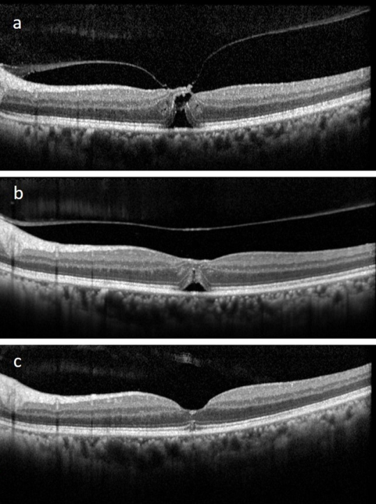 Figure 1: This 74-year-old lady (Case 8) had visual decline in her left eye for about a year. The best-corrected visual acuity (BCVA) was 20/120. a) Optical coherence tomography (OCT) revealed a small full-thickness macular hole (128µ) with vitreofoveal traction. b) A month after intravitreal injection of 0.4mL 100% sulfur hexafluoride gas, the vitreofoveal traction was released, with closure of macular hole. c) Remodeling of the foveal contours continued 3 months post-procedure with a central continuity of the photoreceptor layer. The ellipsoid zone was still interrupted centrally. BCVA had improved to 20/80. Status quo was maintained over the following year.