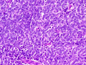 Figure 1: Endometrial stromal sarcoma depicting spherical cells with moderate eosinophilic cytoplasm and atypical nuclei. Surrounding stroma is permeated with vascular articulations. Mitotic figures and tumour necrosis is observed [6].