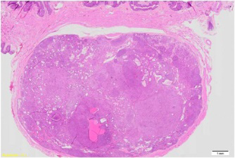 Figure 1: EWSR1::SMAD3 fibroblastic tumour delineating a lobulated neoplasm composed of an acellular, hyalinised centric zone surrounded by peripheral fascicles of spindle shaped cells. Cellular atypia, pleomorphism and mitotic activity is negligible [5,6].