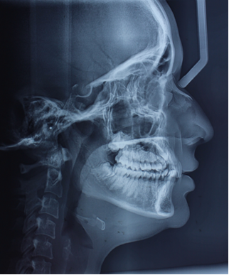Figure 12: Pre- Treatment Lateral Cephalogram.