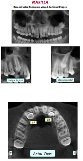 Figure 14: Pre- Treatment CBCT.