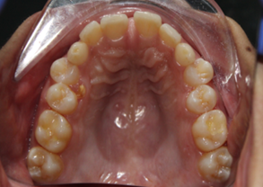 Figure 15: Pre- treatment maxillary occlusal view.