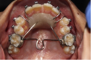 Figure 16: Crab modification of Transpalatal Arch.