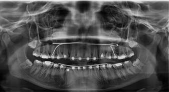 Figure 17: Mid Treatment OPG.
