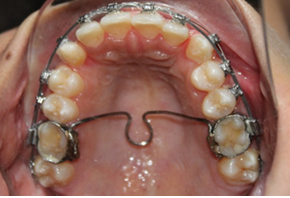 Figure 18: Taken after six months which shows canine eruption in the same.