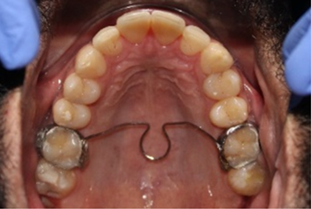 Figure 2: Soldered Transpalatal Arch.