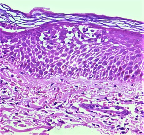 Figure 1: There is marked epidermal spongiosis with spongiotic vesicle containing lymphocytes. Few extravasated red blood cells are seen in spongiotic foci. Superficial dermis shows prominent red blood cell extravasation and perivascular lymphocytes with occasional neutrophils (Hematoxylin-eosin, x400).