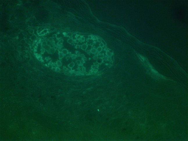 Figure 3: Strong IgA positivity in the intraepidermal vesicle and weak deposits in rest of the epidermis (Direct immunofluorescence, x400).