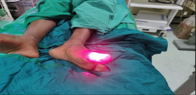 Figure 2: Low level laser therapy to left big toe. Initially patient underwent liposuction assisted debulking. Then patient underwent five session of low level laser therapy (LLLT) once every three days (Figure 3). We used Gallium Arsenide (GaAs) diode red laser wavelength 650nm, frequency 10 KHz and output power 100 Mw. Duration of therapy 125 second every time (Figure 4).