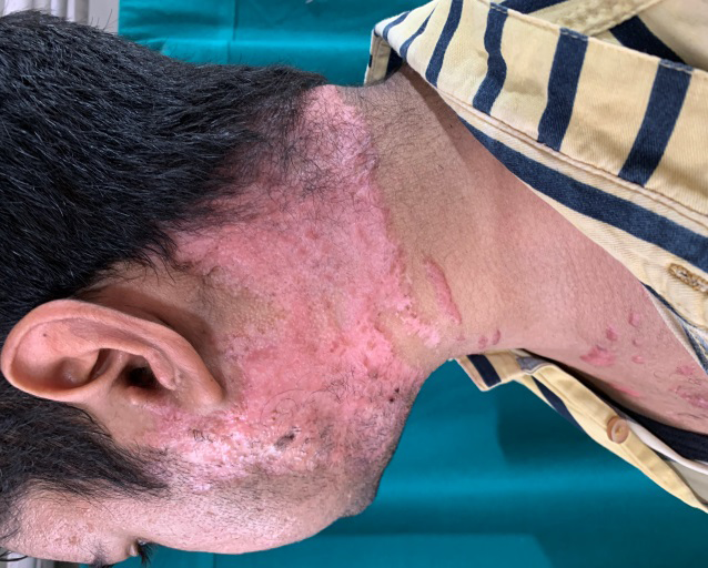 Figure 3: Rapid healing of ulcer within 4 weeks of systemic corticosteroids.