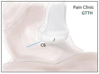 Figure 2: This study employs ultrasound imaging probe- placement  play  a  critical  role  in  the  successful  execu- tion of an ultrasound-guided stellate ganglion block.