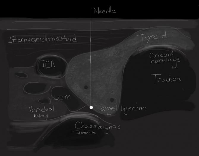 Figure 3: This  study  employs  ultrasound  imaging to  visualize  internal structures and needle placement for  the  purpose  of  performing an ultrasound-guided stellate ganglion block.
