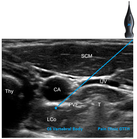 Figure 4: Ultrasound image indicating the C6 level.