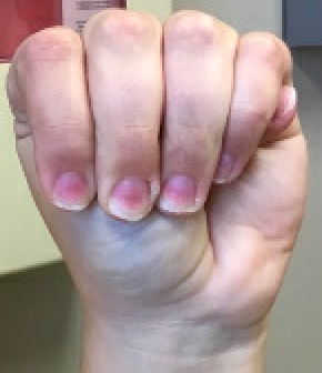 Figure 3: Hyperopposition of the right thumb.