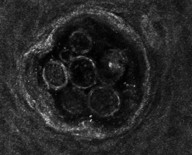 Figure 3: Images obtained using confocal laser scanning microscope VivaScope 1500®(Lucid Inc., Rochester, NY). Hair follicles and sebaceous glands with the presence of Demodex mites. The use of confocal laser scanning in vivo microscope allowed determining the average size of Demodex mites. When determining the size of mites from 100 to 200 μm, it was believed that in this case Demodex folliculorum brevis was observed, while the average length of the mite was 125 μm; from 200 to 400 μm - Demodex folliculorum longus with an average length of 293 μm. The average size Skin scraping, squeezing out the contents of the sebaceous glands followed by microscopy of the Demodex mite width was 24 μm. When measuring the size of the follicular entrance and estimating their number per unit area for which a randomly chosen site of 25 mm2 was taken, statistically significant differences between the three groups were revealed (p <0.01). It was established that the size of the follicular entrances and their number per unit area in all three groups differ significantly (Tables 10 & 11).