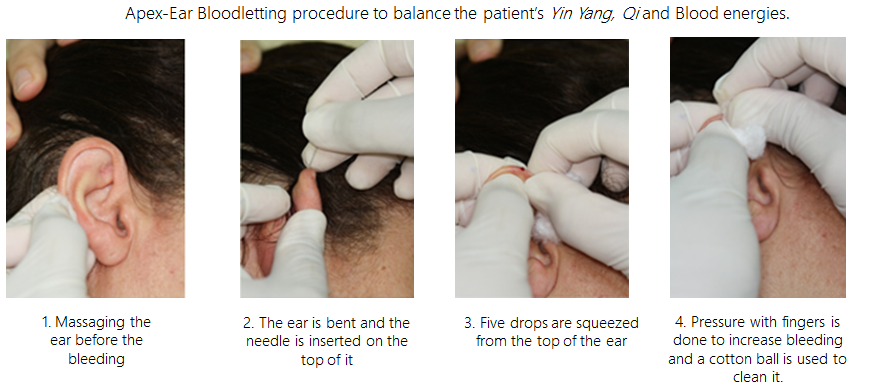 Figure 7: Apex ear bloodletting.