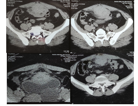 Figure 1: CT scan revealing adhesions of the mass to the bladder dome and intestinal tract.