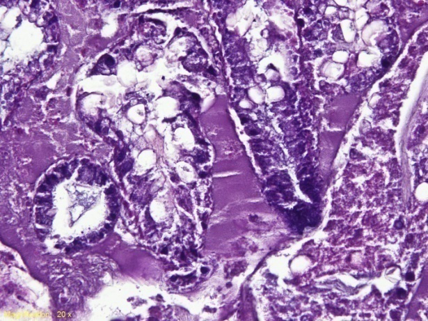 Figure 2: ** Histology of Mud Crab Hepatopancreas. Magnification 200x. Severe heavy damages were seen in the Bombana Mud Crab samples (Figures A1 and A2) and light damage in the Mangrove Crab samples in Lakara Village (Figures B1 and B2). Hepatopancreas have necrosis tissues. (1) Liver cell necrosis, (2) Liver cell vacuolation (A1); (1) Liver cell necrosis, (2) Liver cell vacuolation, (3) Hemorrhagic (A2); (1) Vacuolization of liver cells, (2) Infiltration of mononuclear cells (B1); (1) Necrosis of liver epithelial cells (B2).