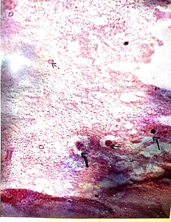Figure 11: Showing the infected portion of tissue by bacteria in Macrobrachium rosenbergii.